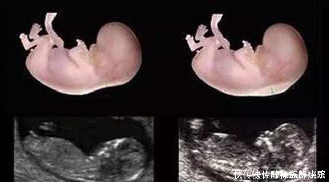 b超|孕期产检不想生个“傻孩子”,这三项产检必须按时做,不能忽视