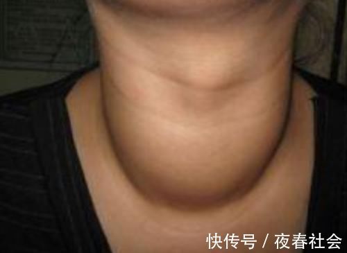 冬瓜|甲状腺结节的“克星”找到了，经常吃，化瘀散结，结节悄悄变小！