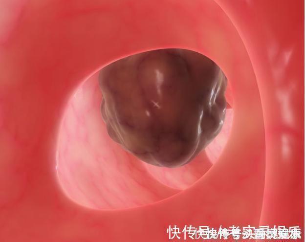 癌症|息肉和癌症有什么关系告诫3个部位长息肉，最好及时切除