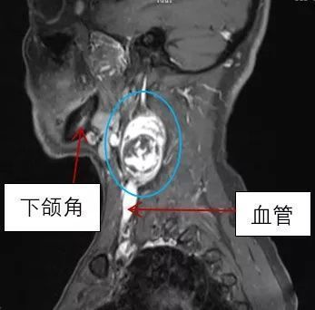 神经纤维瘤|医院先后来了两个男子,毛病几乎一样脖子上长了“鹌鹑蛋”,按按手还有触电的感觉……
