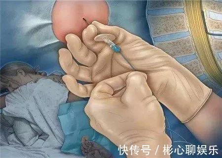 手术|剖腹产到底要挨几刀没你想的那么简单，只有经历过的人才懂