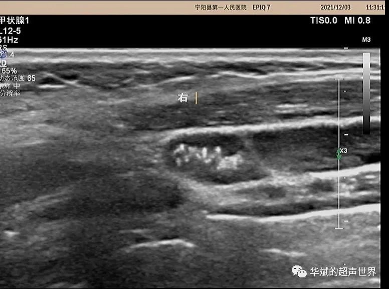 淋巴结|超声问答丨这个颈部淋巴结应该如何考虑？