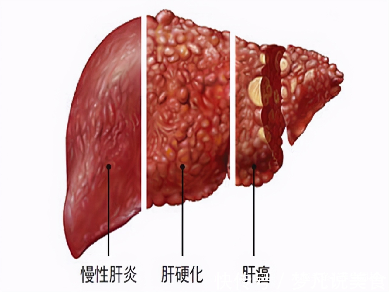 患者|放屁多是肝硬化前兆放屁程度越高，病情越严重