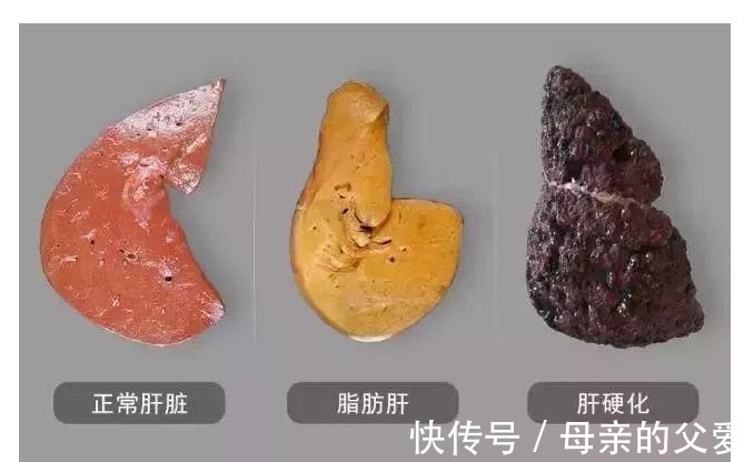 肝脏|肝脏不好的人,身体或有这6个表现,不妨自测一下