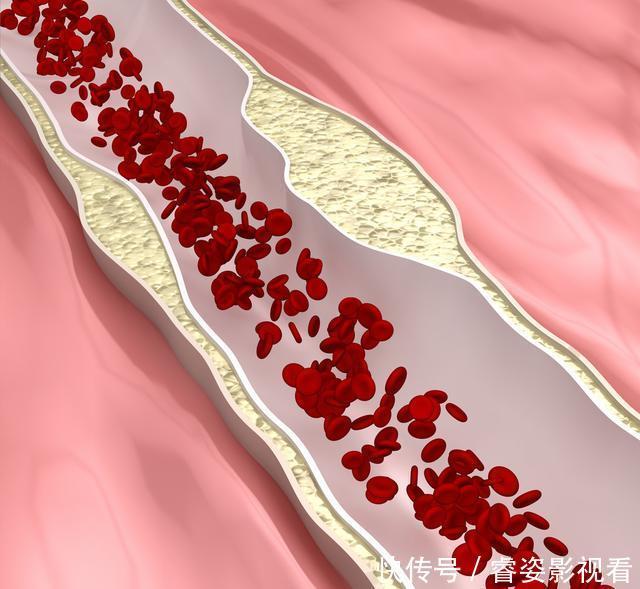 丹参片能不能长期服清理血管垃圾？看完医生这篇文章就知道了