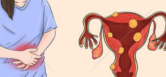 黏膜下肌瘤|子宫肌瘤生长的位置不同，竟隐藏着巨大风险.....