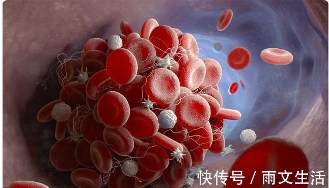 血管堵塞|血管的“去污剂”不是芹菜，平时紧着吃，给血管冲冲澡，血脂降了