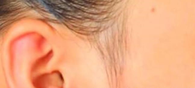 眼角膜|血脂高不高,看脸便知晓?脸上出现4大表现,要注意降低血脂了