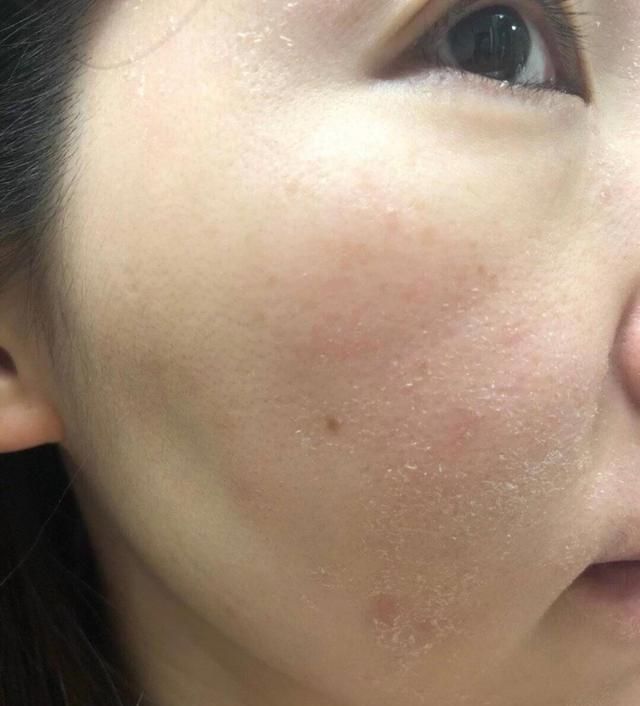 红血丝|判断你是不是“敏感肌”?看脸上这几个地方,很简单就能看出来!