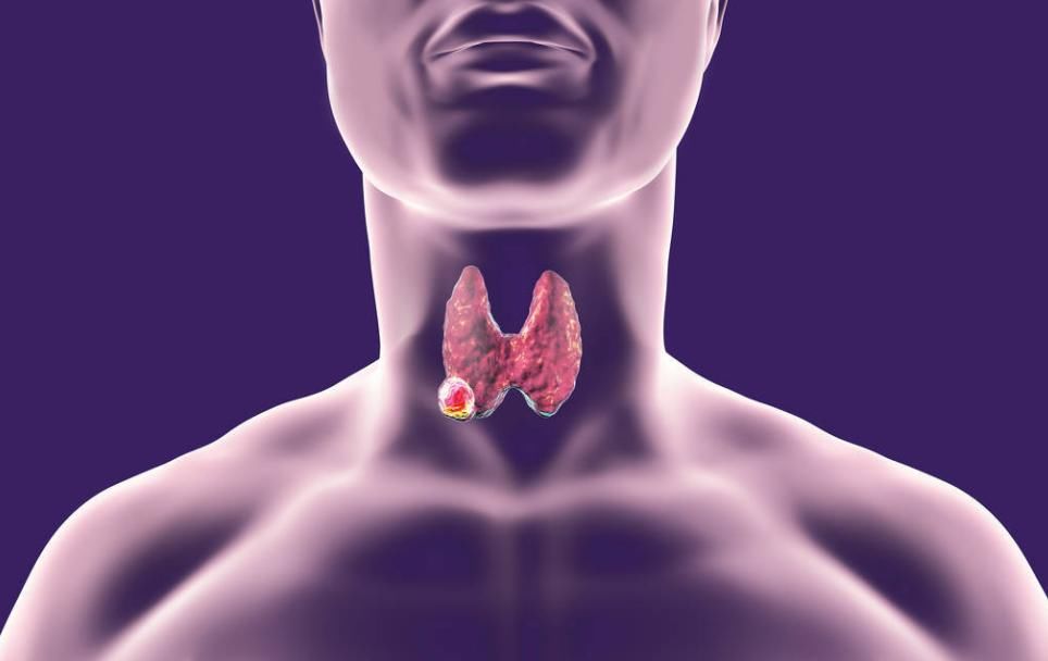 食物|甲状腺结节患者不能喝豆浆?内分泌院士:这3种食物才需要远离