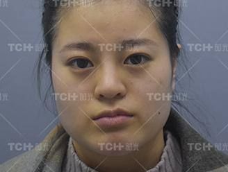 案例分享丨国字脸下颌角+颧骨颧弓手术案例分析