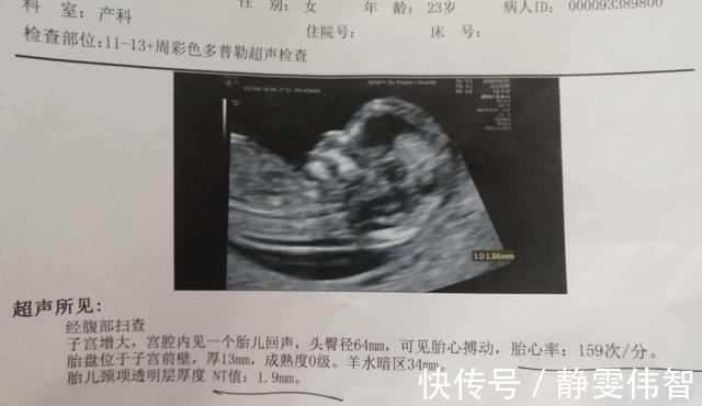 检查|孕期这项检查，能率先查出畸形儿，产妇却崩溃比高考还难通过