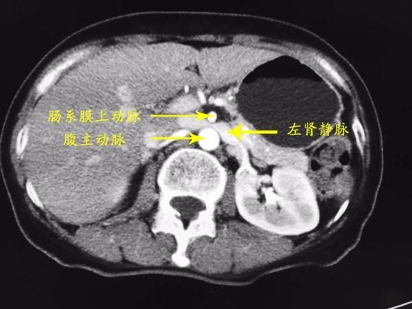 蛋白尿|反复腰疼、血尿？泌尿外科提醒：请小心胡桃夹综合征！