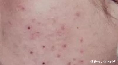 在这个看脸的社会,不注意这些,小心痘印“毁容”