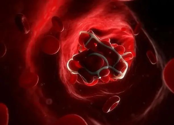 深静脉血栓|血栓形成后,腿脚容易出现4个异常,若一个没有,血管还算通畅