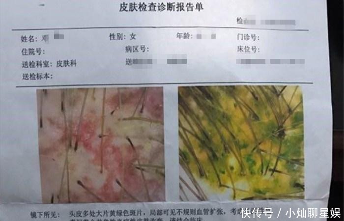 住进|女子爱美染发7小时, 不料操作失败后被剃光头住进了医院