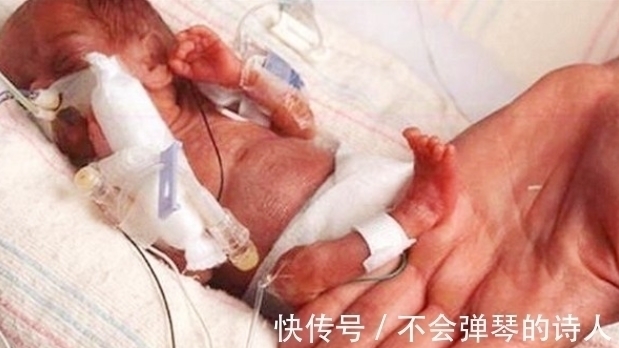 生命力|出生时仅25厘米的“拇指姑娘”,曾被断言活不过3月,却健康长大