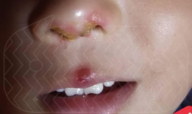 鼻子里面反复结痂流脓