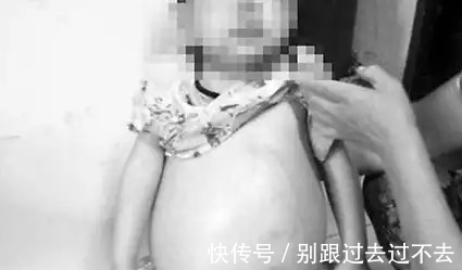 畸胎瘤|7岁小女孩肚子越来越大,去医院检查竟真的怀有胎儿