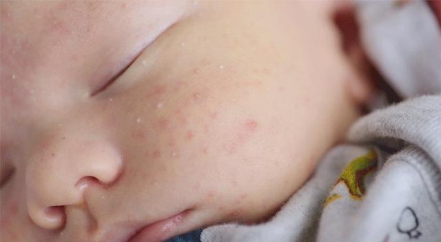 会长|新生儿也会长“青春痘”?这事全怪家长