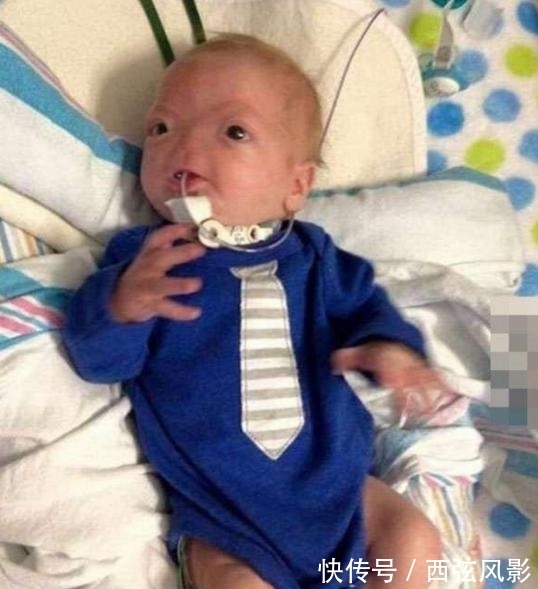 鼻子|小男孩刚出生就没有鼻子,但是他的笑容感染了多少人