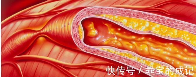 血液粘稠|高血脂的罪魁祸首找到了,不是肥肉,医生:饭后2件事早就该改掉