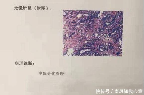 一文读懂肿瘤分期
