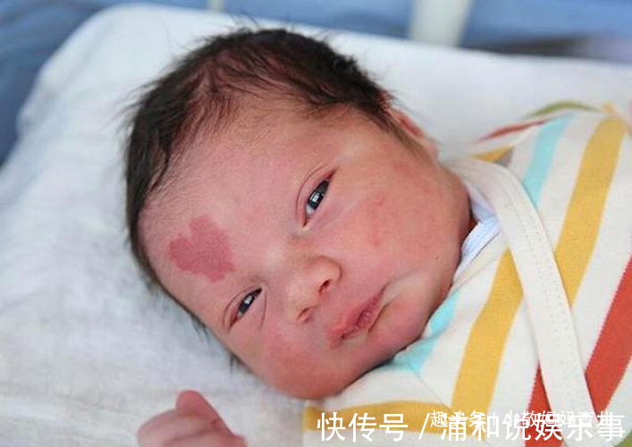 产科医生|胎记是怎么来的?妇科医生:除了遗传,孕期尽量避开这3种行为