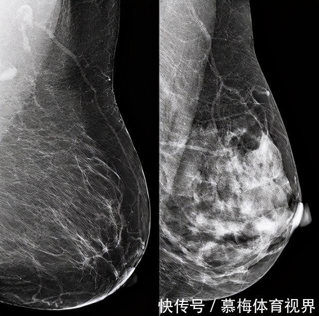 乳腺癌|女人请听好:想远离乳腺癌的威胁,4件小事要坚持做