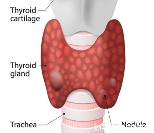 乳腺結節|甲狀腺結節、肺結節，體檢單上的結節距離“癌癥”還有多遠？