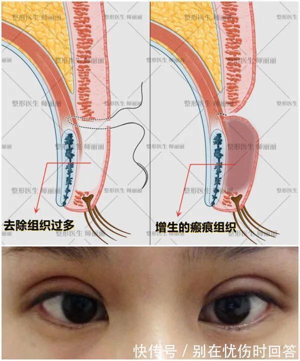 瘢痕 双眼皮术后出现肉条的不同原因和修复方法