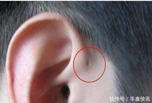 儿子|儿子的耳朵上有个小洞宝妈试图挤压,导致孩子昏迷,被送到医院