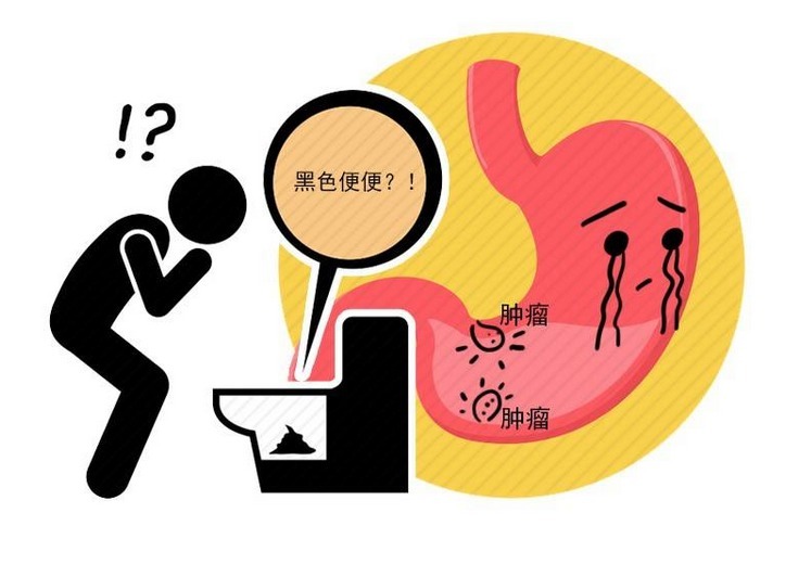 病情|是胃癌还是胃病?4个症状出现,警惕胃癌发出的征兆,别混淆了