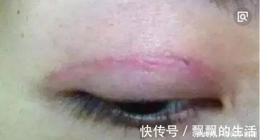 手术|手术割了双眼皮的人,老了之后有什么影响?看完真要留意了