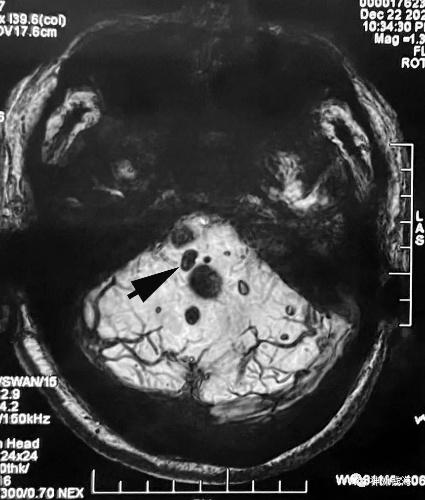 海绵状血管瘤|一例脑干海绵状血管瘤的手术陷阱
