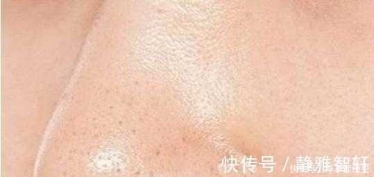 鼻子|女生鼻子上能挤出“毛毛虫”?教你3个小妙招,远离“草莓鼻”!