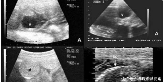 产妇|产妇生下无脑宝宝,夫妻不离不弃照顾3年,现状如何