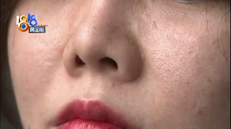“壹加壹”修复鼻子，“朝天鼻”没有改善？