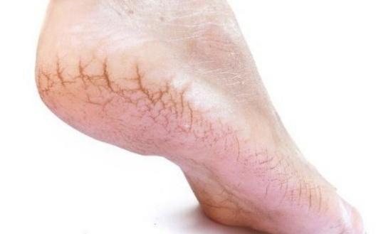 症状|有无糖尿病伸出脚就知道,若有3个“症状”,可别忽略了