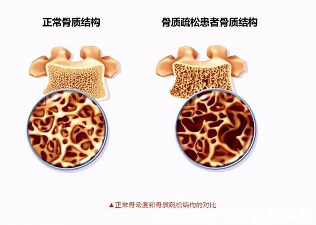 食物|女人过了50岁,这2种食物要舍得吃,或能帮你预防骨质疏松