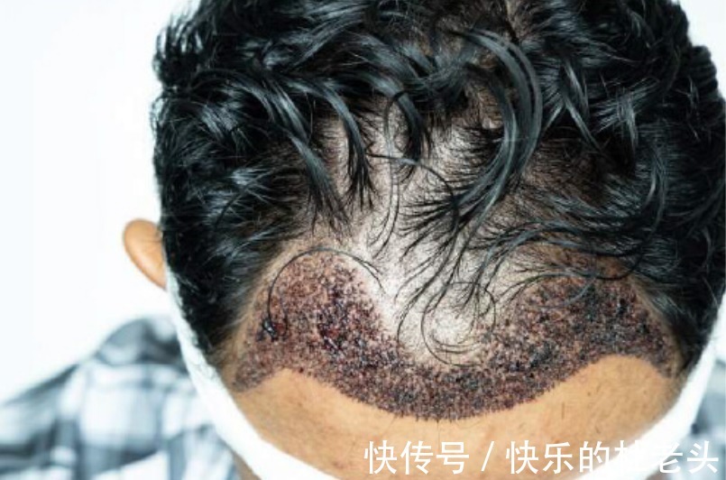移植 植发后会掉发吗?谁要说百分百不掉发,不是心黑就是无知!