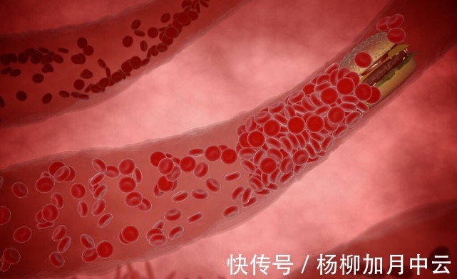 心脑血管疾病|散步可以降血脂吗医生多吃3种食物,或比散步效果要好