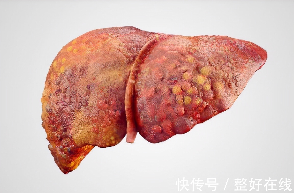 张雅丽|肝硬化晚期还能活多久?专家提醒:饮食上做到4点或延长生命周期