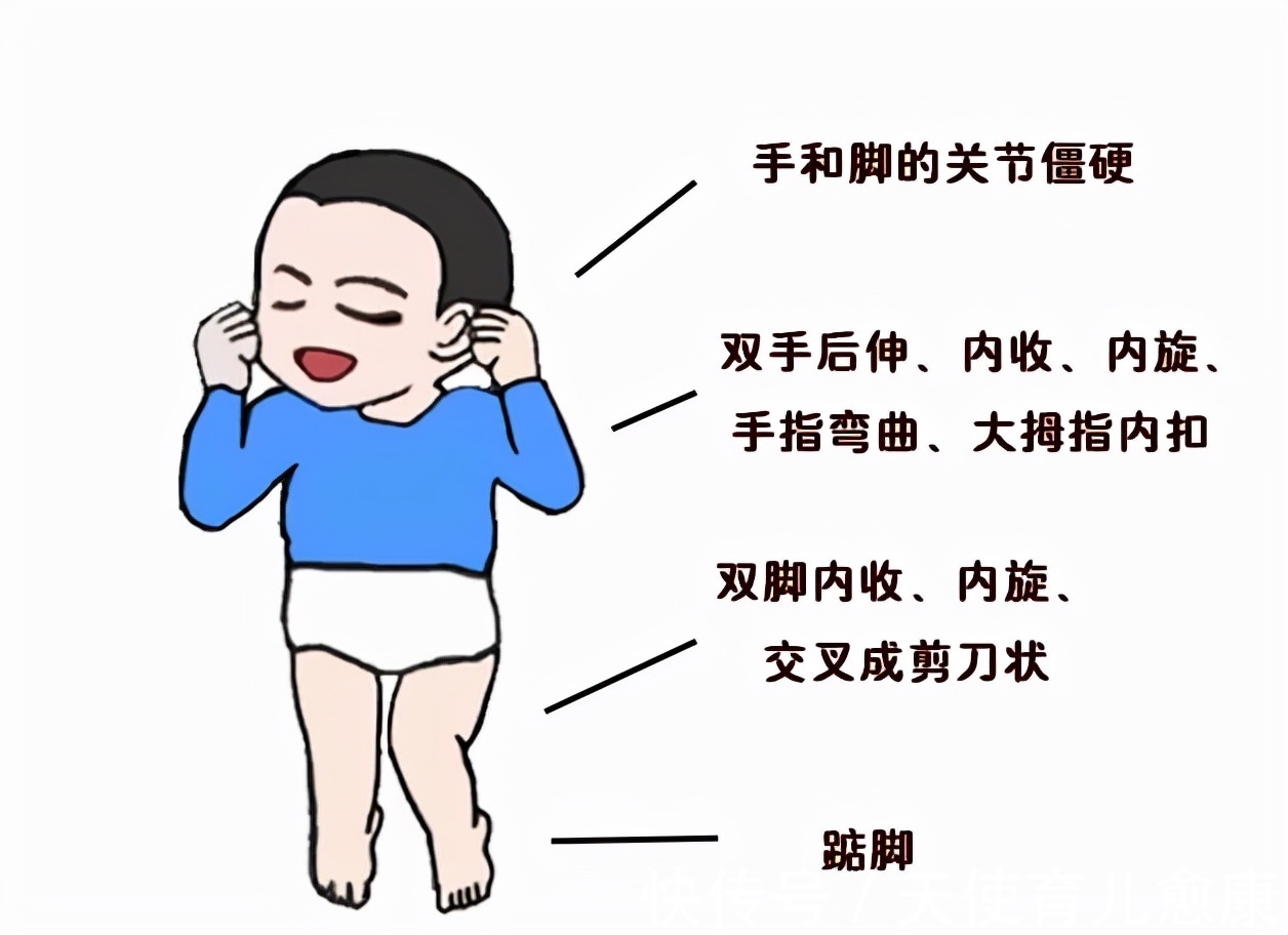 儿童|天使科普:10种方式判断脑瘫儿童的早期症状
