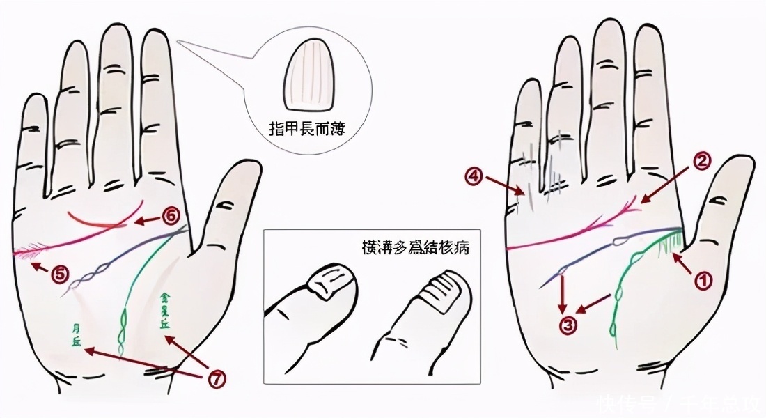 诊断|掌纹可以诊断肝癌、糖尿病、高血压、妇科病、脑溢血