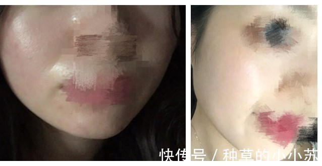 玻尿酸|皮肤干燥起皮“很难受”护肤品店老板教我这样做,皮肤滋润不起皮