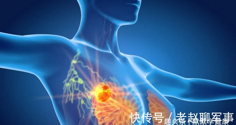 乐启生|48岁确诊乳腺癌晚期,从逃避到重生,8年时间她总结出抗癌秘诀