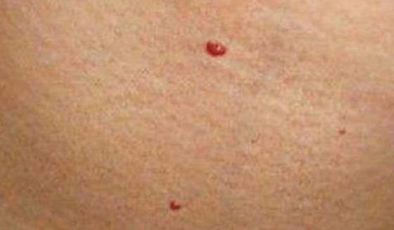 洪志|身体上莫名长出“小红痣”，是怎么回事？需要去做检查吗？