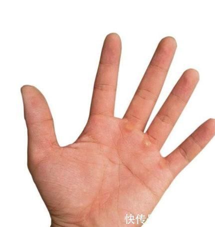 发红|身体2个地方发红、2个地方出血,糟糕:肝硬化“上身”了,勿忽视