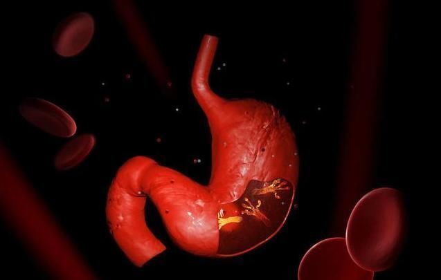 卷心菜|胃不好的人放心,幽门螺杆菌其实不难除,只是需要注意3点